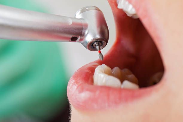 Best Root Canal Emergency Dentist  in Anchor Point, AK